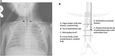 Comparisons and Refinements of Neonatal Oro-Tracheal Intubation Length Estimation Methods in Taiwanese Neonates